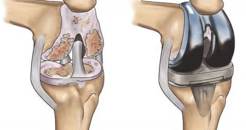 Total Diz Protezi Ameliyatı