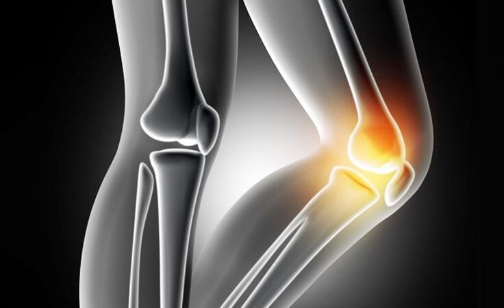 Menisküs Yırtığı Nedir?
