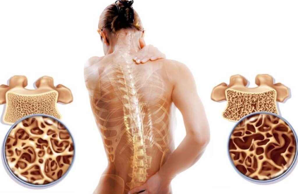 Kemik Erimesi Nedir?